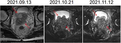 A case report of sustained remission after radiotherapy combined with ICI in NEPC with primary drug resistance to chemotherapy